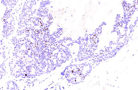 Endocrine Mucin Producing Sweat Gland Carcinoma Reappraisal Of Patient