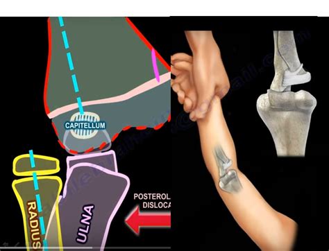 Paediatric Elbow Dislocation And Differential Diagnosis