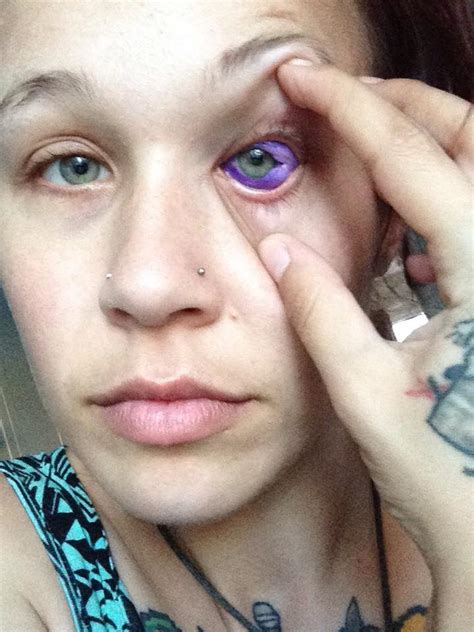 Canadian Woman Could Go Blind After Getting Eyeball Tattooed Photos Daily Hive Montreal
