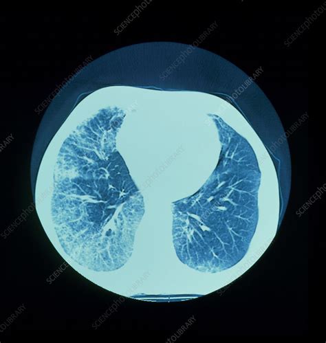 Ct Scan Of Lungs Showing Interstitial Fibrosis Stock Image M160