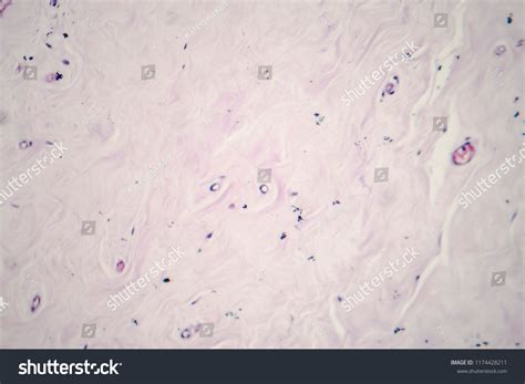Fibroadenoma Benign Breast Tumor Light Micrograph Stock Photo