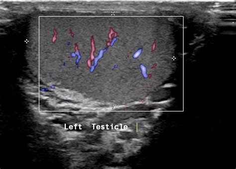Testicular Scrotal Scan Ultrasound Scan