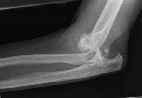 Dislocated Elbow Buyxraysonline