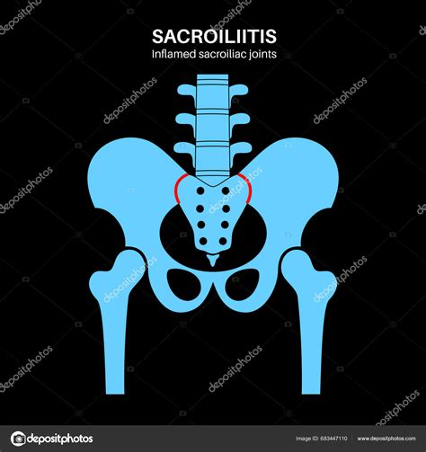 Sacroiliitis Disease Concept Inflamed Sacroiliac Joints Lower Spine