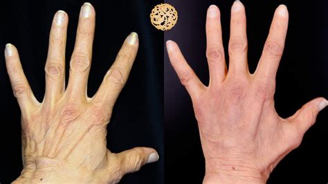 Hand Rejuvenation Before And After Beverly Hills