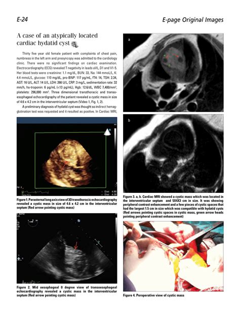 Pdf A Case Of An Atypically Located Cardiac Hydatid Cyst