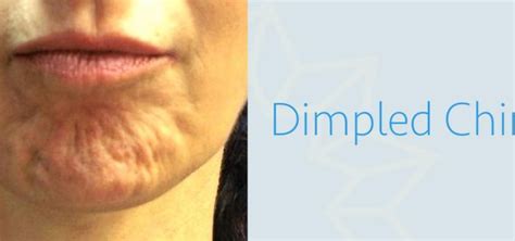 Botox For Dimpled Chin Orange Peel Texture