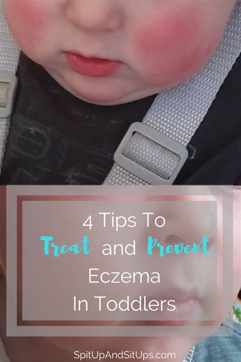 How To Treat Eczema In Toddlers And Babies How To Treat Eczema