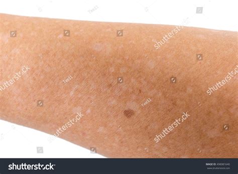 Small White Spots On Arms IdiopathicẢnh Có Sẵn498981640 Shutterstock