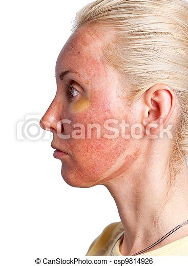 Cosmetology Skin Condition After Chemical Peeling Tca The Beginning