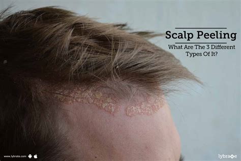 Scalp Peeling What Are The 3 Different Types Of It By Dr Abhinav