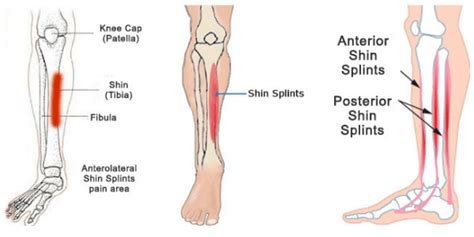 Can Skiing Cause Shin Splints Boot Injury Snow Gaper