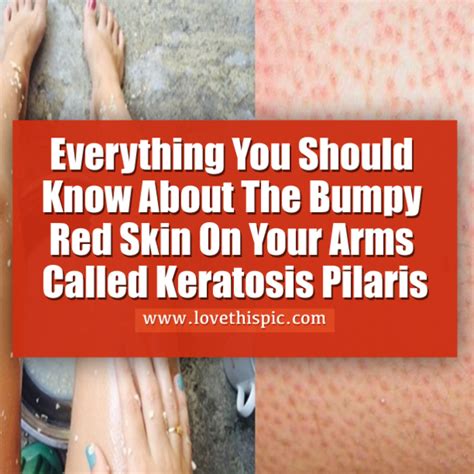 Everything You Should Know About The Bumpy Red Skin On Your Arms Called