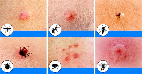 How To Recognize And Treat The Most Common Bug Bites Bug Images And Photos Finder