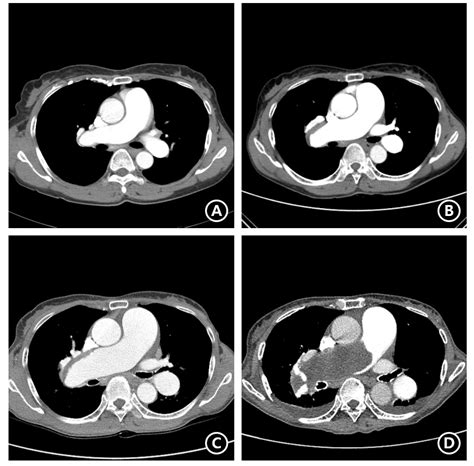 Chronological Computed Tomography Ct Findings A First Follow Up Ct