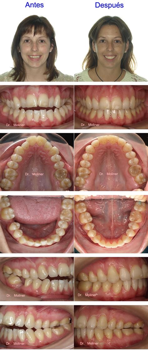 Mordida Abierta Brackets Damon Ortodoncia Moliner Zaragoza