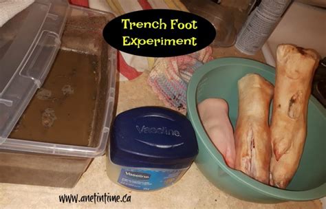 Trench Foot Experiment A Net In Time