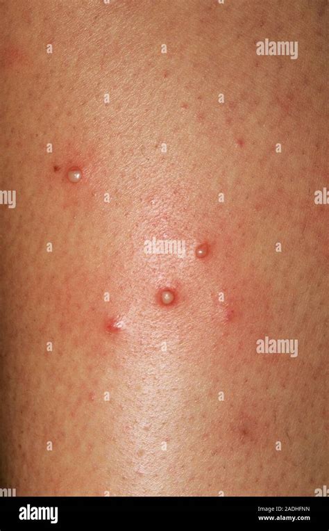 Folliculitis 28 Year Old Woman With Red Skin Lesions Folliculitis On