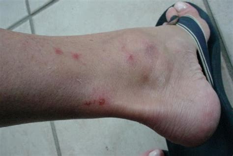 Ankle Bites Pictures Photos