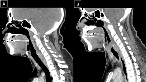 Observation Of Retropharyngeal Fluid Collection In 2 Covid 19 Positive