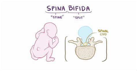 Nursing Diagnosis And Interventions For Spina Bifida Nanda Nurse