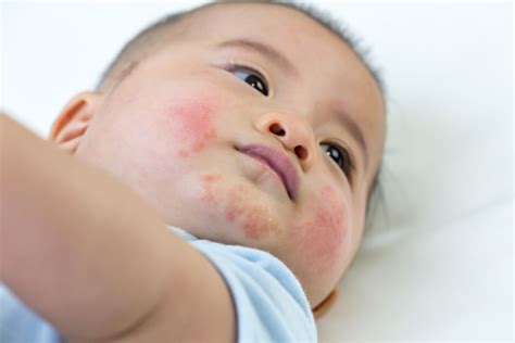 Allergic Reaction On The Face Causes And Treatments