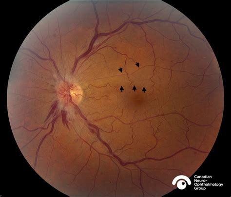 Blood And The Thin Pale Linecanadian Neuro Ophthalmology Group