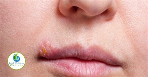 Home Remedies Fever Blisters Lips Home Remedies For Fever Natural Home