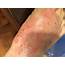 What Is Eczema  Skinsharesg