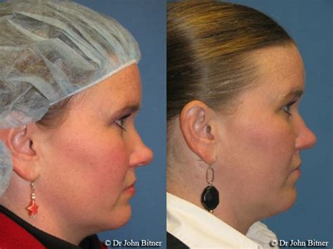 Most insurance plans cover our procedures. Rhinoplasty Layton, UT | Salt Lake City | Bitner Facial Plastic Surgery