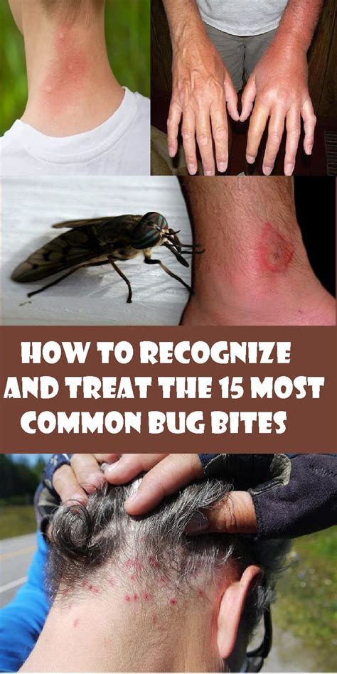 How To Recognize And Treat The Most Common Bug Bites Bug Bites Intense Itching Body