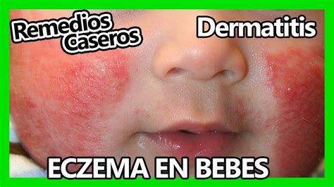 Remedios Caseros 🍵 Para El Eczema En Bebes 👶 Vive Saludable Youtube