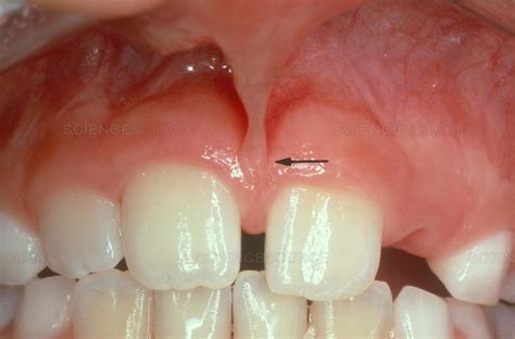 Frenulum In The Mouth My Best Dentists Journal Mybestdentists
