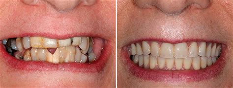 Dental Implants Restorative Dentistry New Paradigm Dentistry