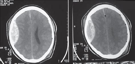 Cranial Ct Scan Showing A Right Frontoparietal Extradural Hematoma That