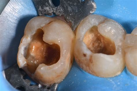 Cavities On Wisdom Teeth Restored Cavities On Wisdom Teeth Restored