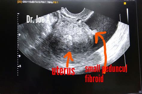Ultrasound Imaging Small Pedunculated Fibroid