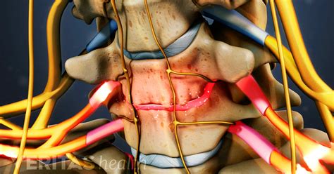 Considerations For Cervical Disc Replacement Surgery