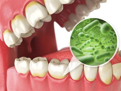 Infección Bucal ¿cómo Prevenirla Clínica Dental Rodolfo Pita