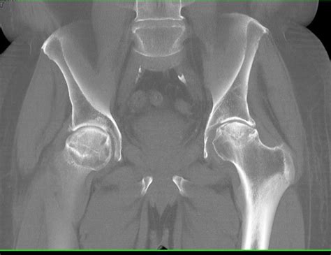 Avascular Necrosis Both Femoral Heads But Worse On The Left Side