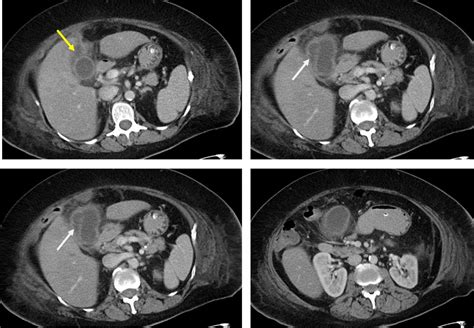 Gallbladder Empyema Radiology Cases