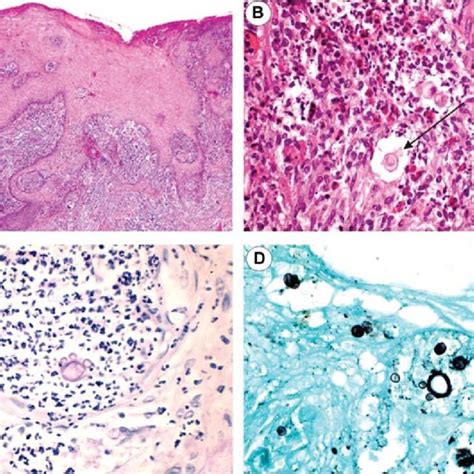 Submandibular Lymph Nodes Paracoccidioidomycosis Granulo Matous