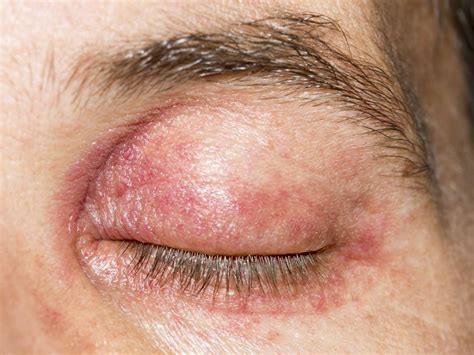 12 Causes And Treatments Of A Swollen Eyelid Stye Chalazion Allergies