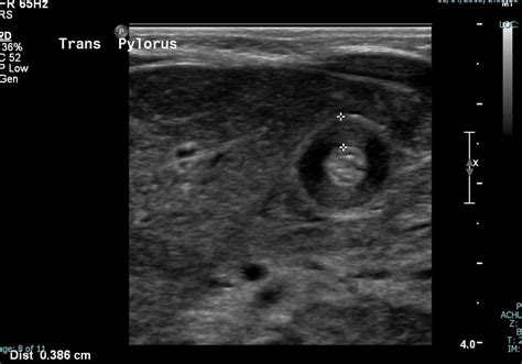 Pyloric Stenosis Uams Department Of Radiology
