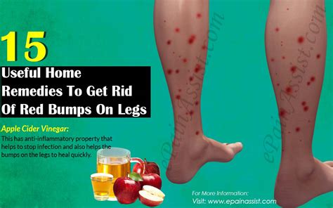 15 Useful Home Remedies To Get Rid Of Red Bumps On Legs