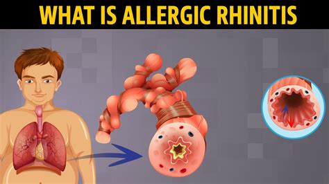 What Is Allergic Rhinitis Youtube