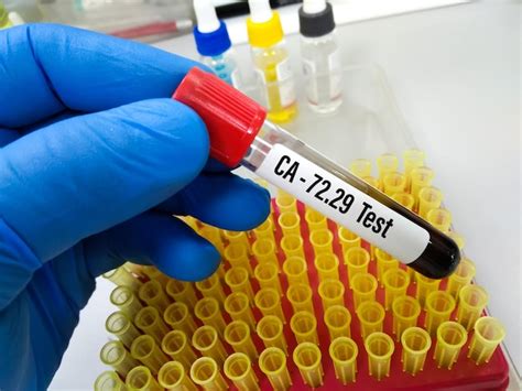 Premium Photo Blood Sample For Ca 2729 Test Diagnosis For Breast