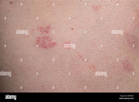 Herpes Zoster Rash Blisters Hi Res Stock Photography And Images Alamy