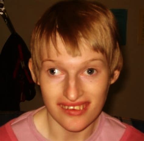 Angelman Syndrome Pictures Symptoms Causes Treatment Life