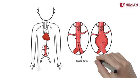 What Is An Abdominal Aortic Aneurysm Youtube